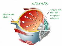 Bệnh glaucoma tiến triển thầm lặng gây mù lòa